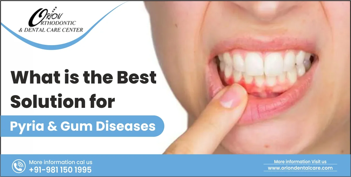 You are currently viewing What is the Best Solution for Pyria and Gum Diseases