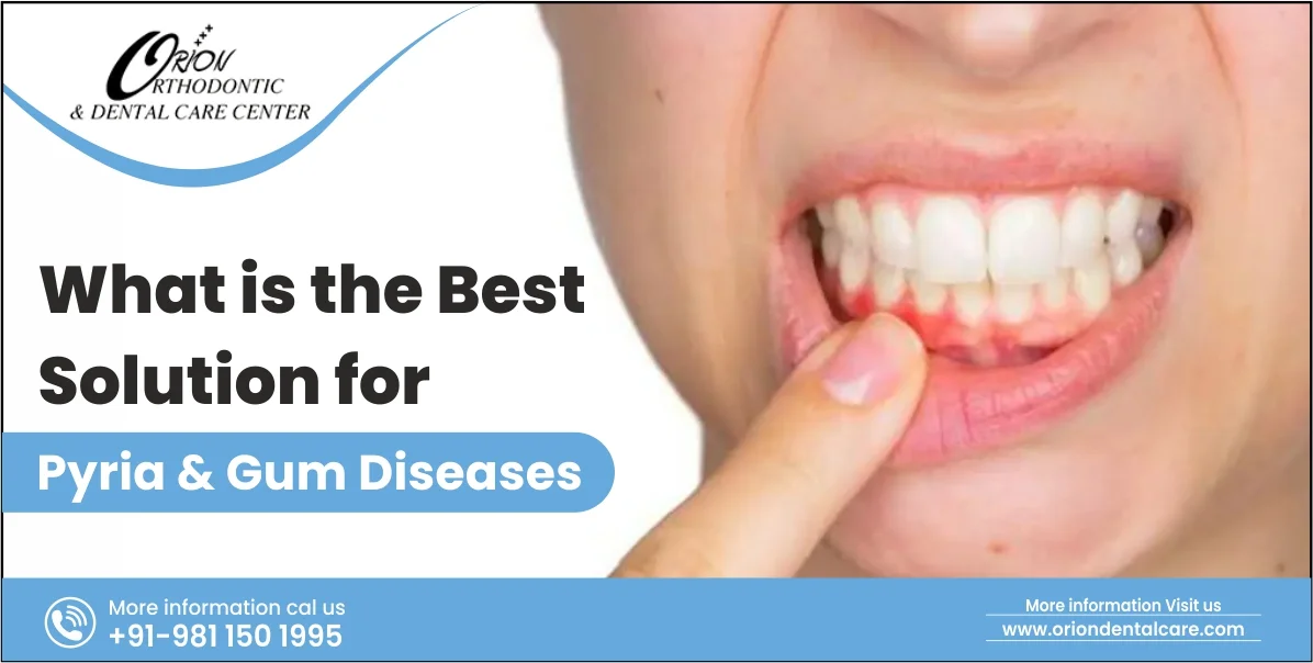 You are currently viewing Best Solution for Pyria and Gum Diseases