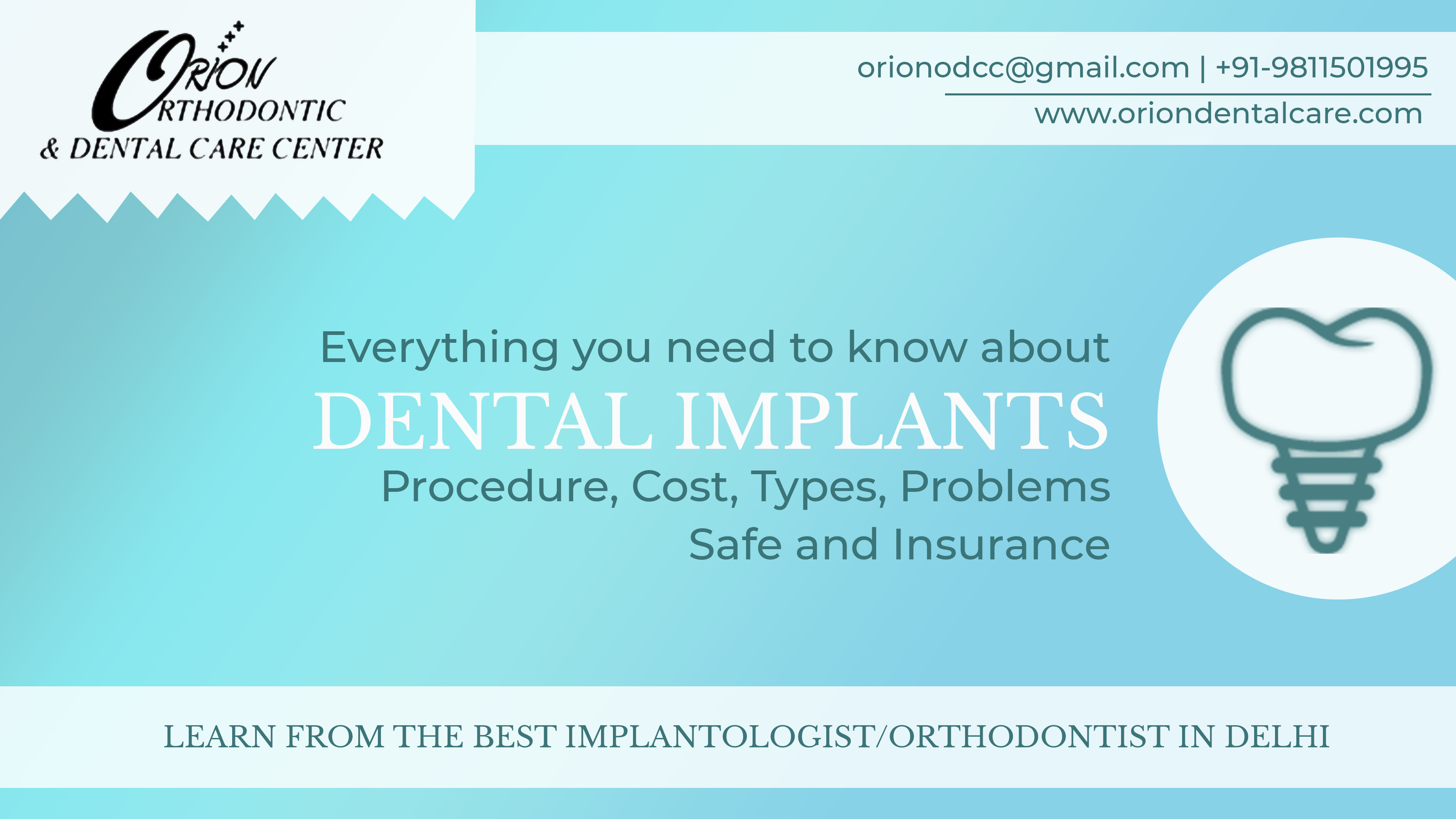 Read more about the article Dental Implants