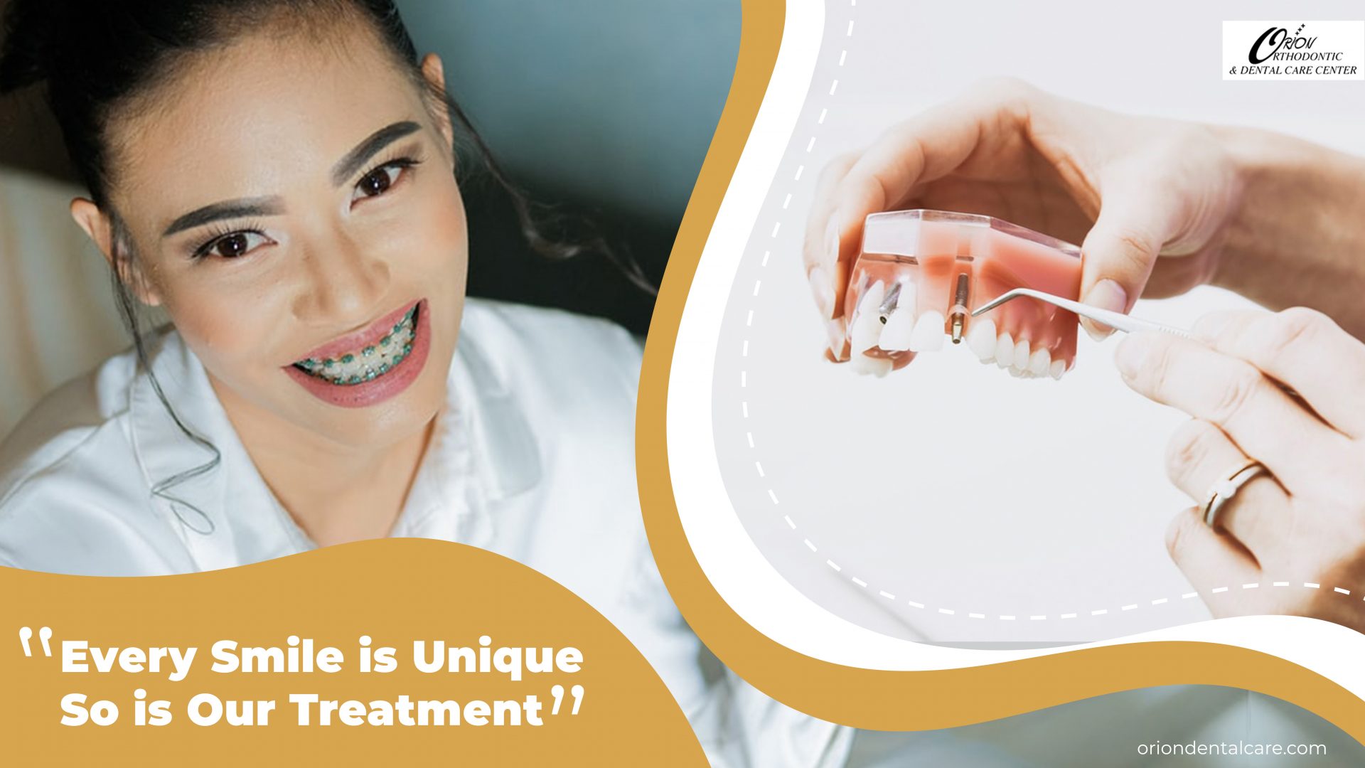 You are currently viewing Best Dental Braces Cost in Delhi – Choosing The Best Option For You