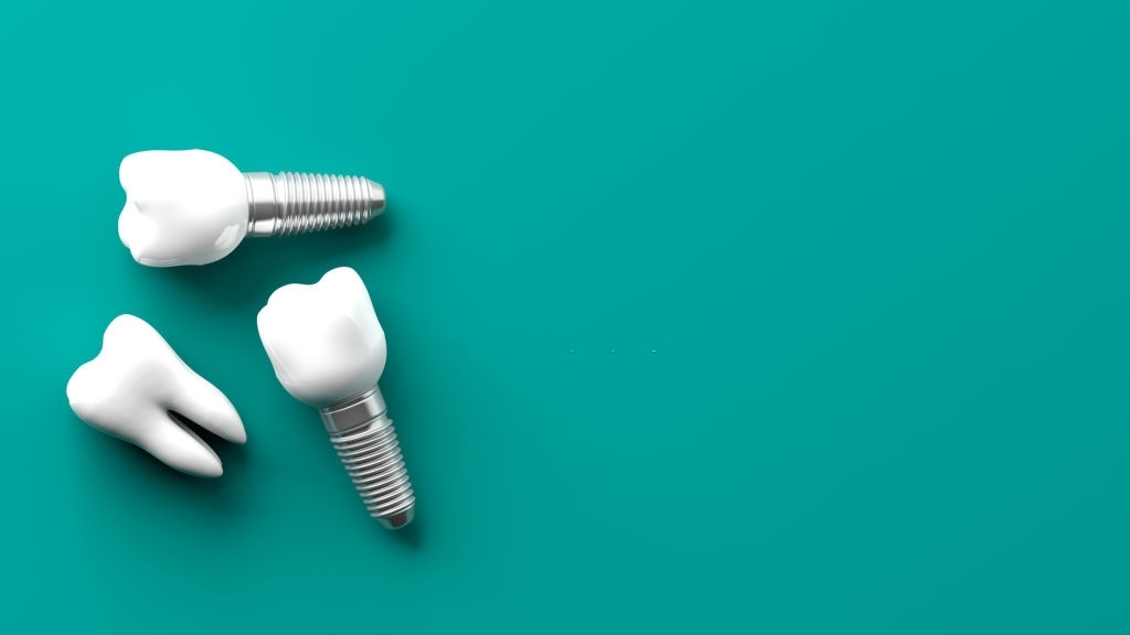 You are currently viewing Dental Implants! As Good As Natural Teeth at Orion Dental Clinic