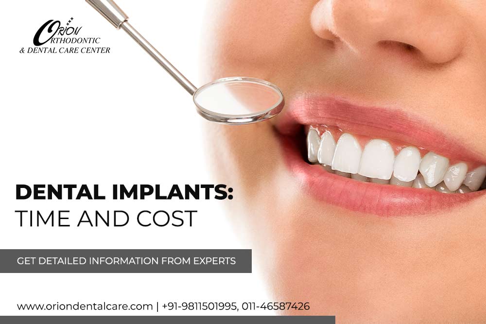 Read more about the article Dental Implants: Time and Cost – Get Detailed Information from Experts