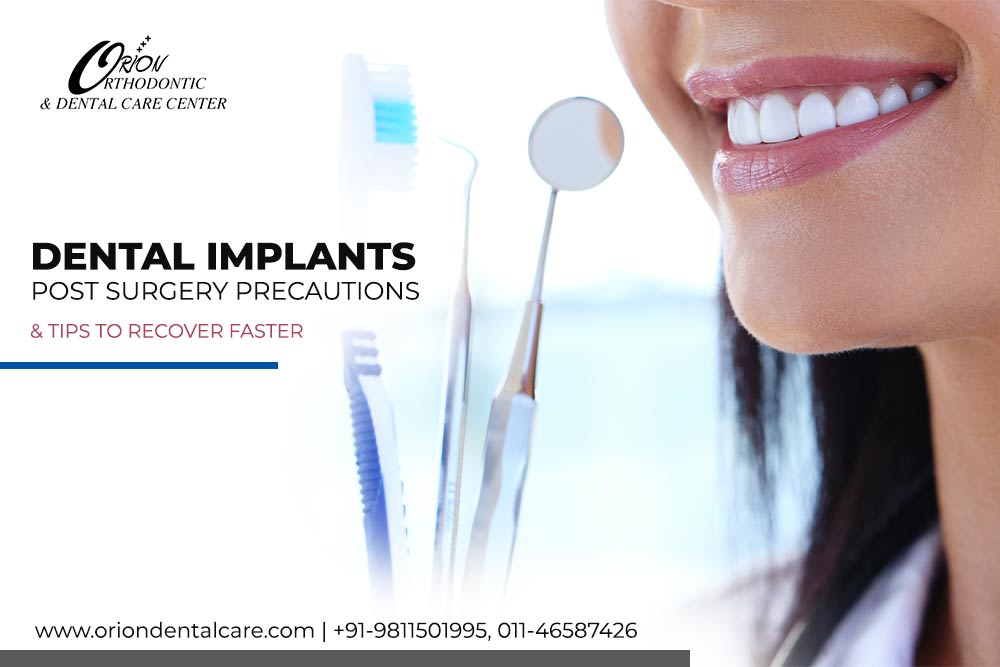 You are currently viewing Dental Implants – Post-Surgery Precautions & Tips To Recover Faster