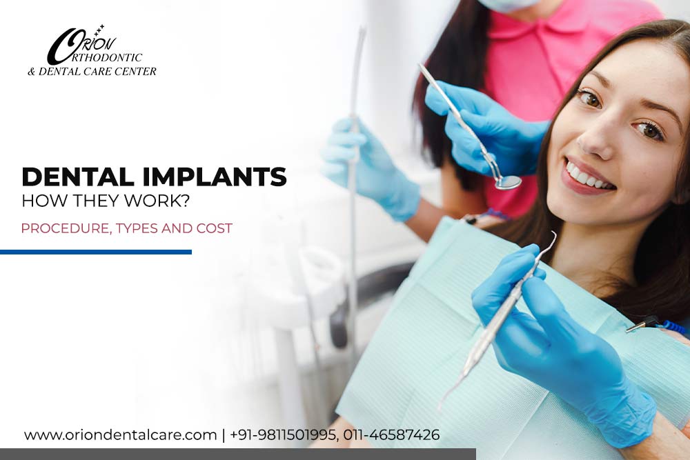 You are currently viewing Dental Implants: How they work? Procedure, types and cost