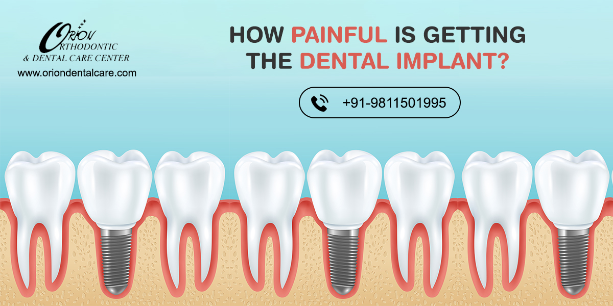 You are currently viewing How Painful is Getting The Dental Implants