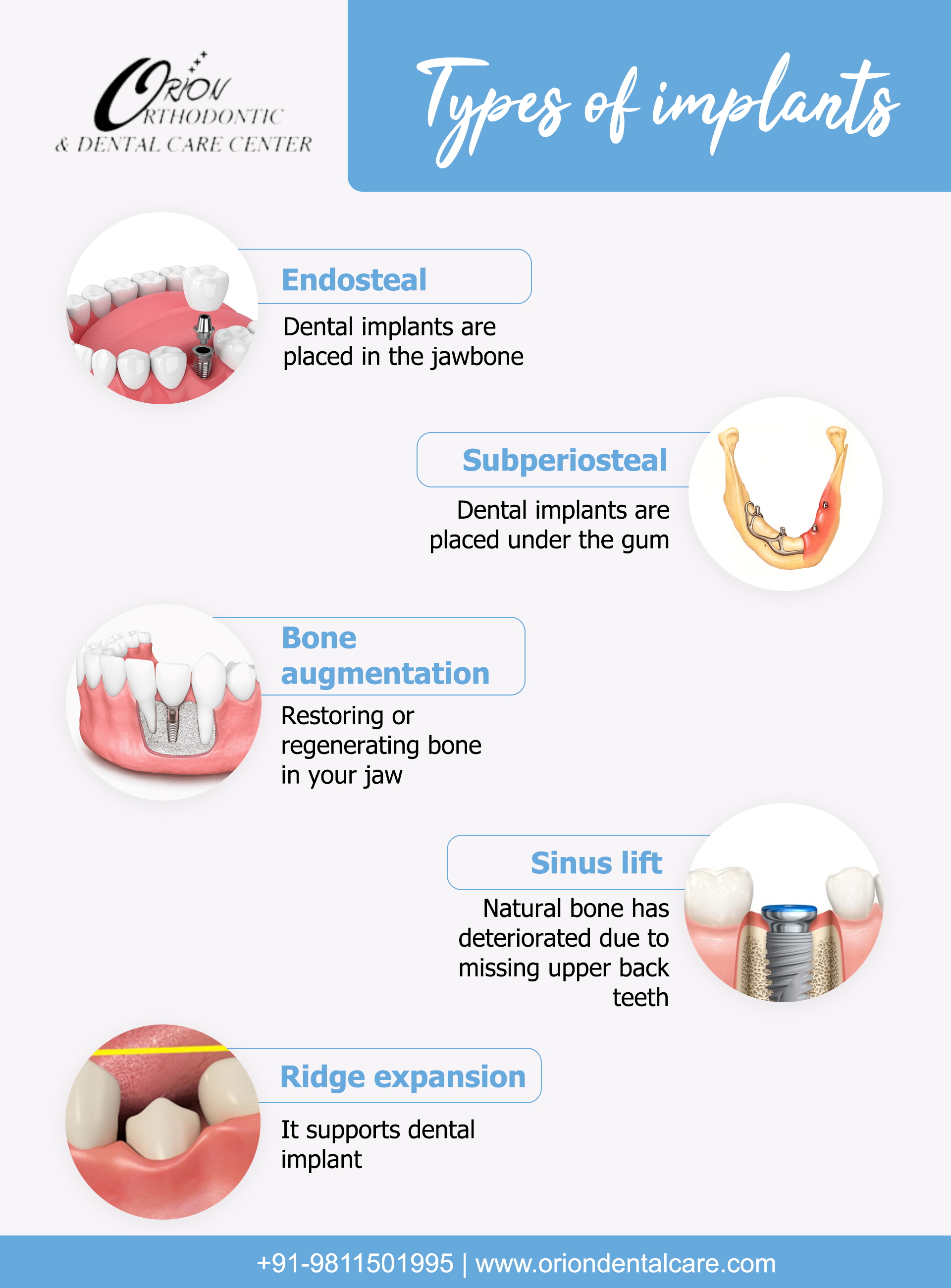 types of Dental Implants
