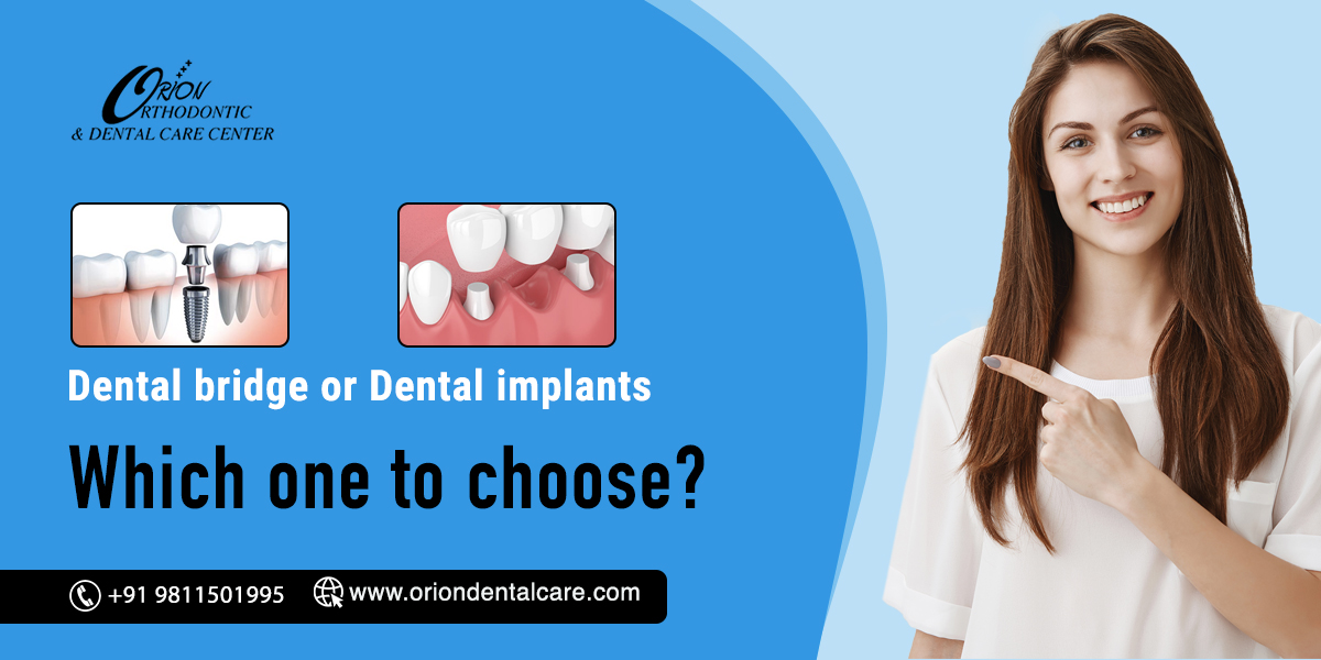 Read more about the article Is it better to get a dental bridge or dental implants?