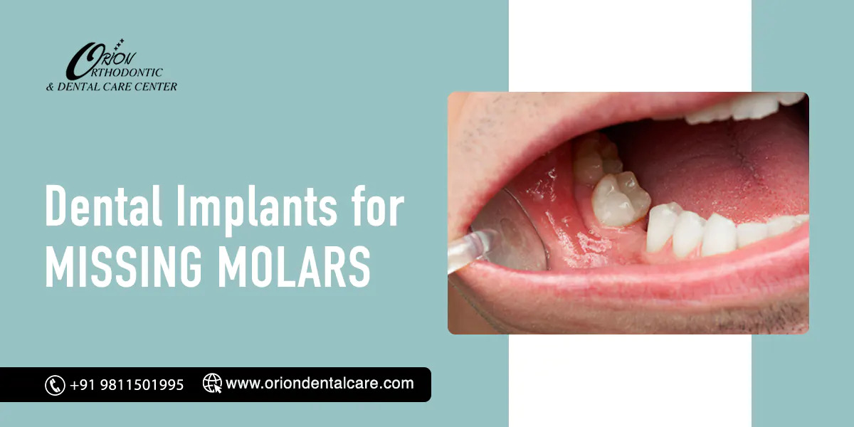 Read more about the article Dental Implants for Missing Molars: What Patients Should Know?