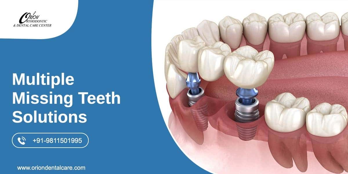 Read more about the article Multiple Missing Teeth Solutions with Dental Implants