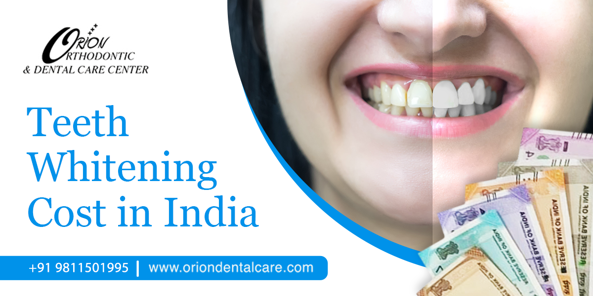 You are currently viewing Teeth Whitening Treatment Cost in India: How Long Does Teeth Whitening Last?
