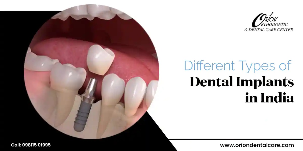 You are currently viewing Dental Implants In India: Types of Dental Implants in India