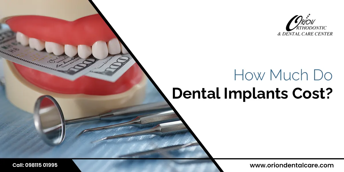 Read more about the article Dental Implants Cost in India: How Much Does Dental Implants Cost?