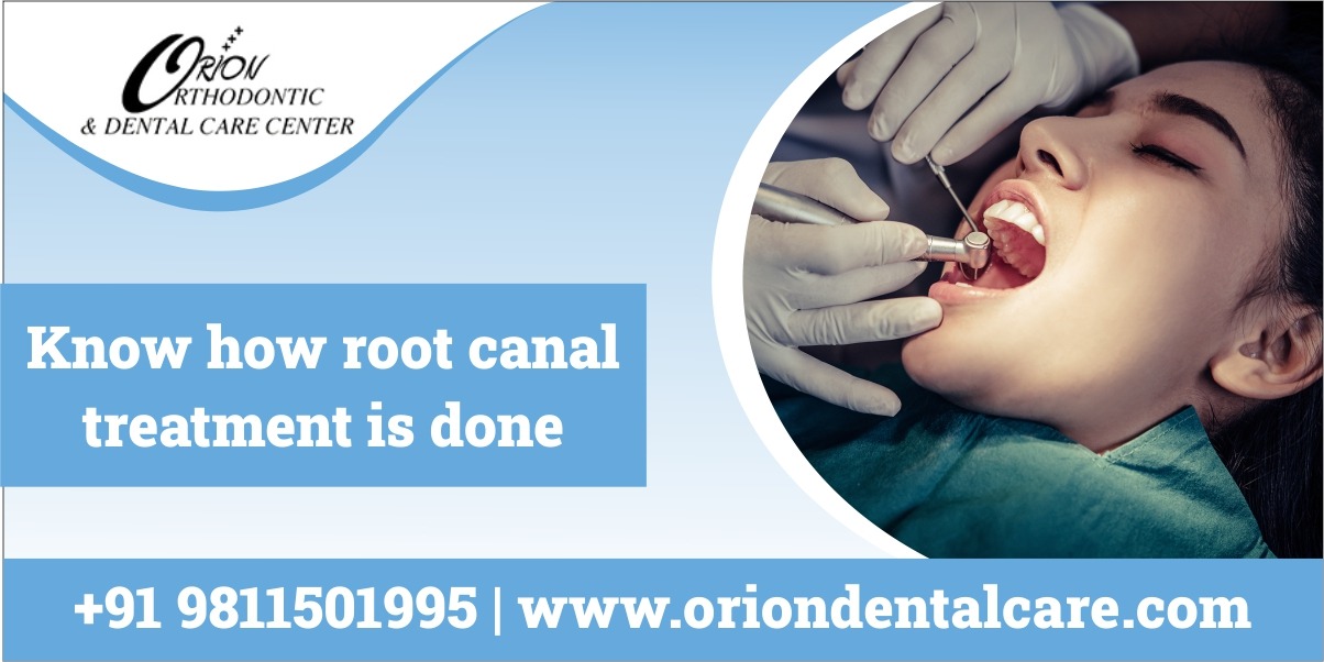 You are currently viewing Step-by-Step Guide to Root Canal Treatment