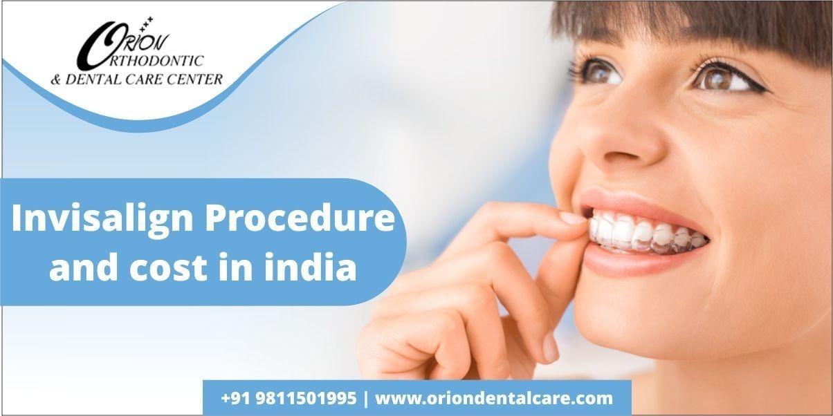 Read more about the article How Does Invisalign Work? | How Much Does Invisalign Cost in India?