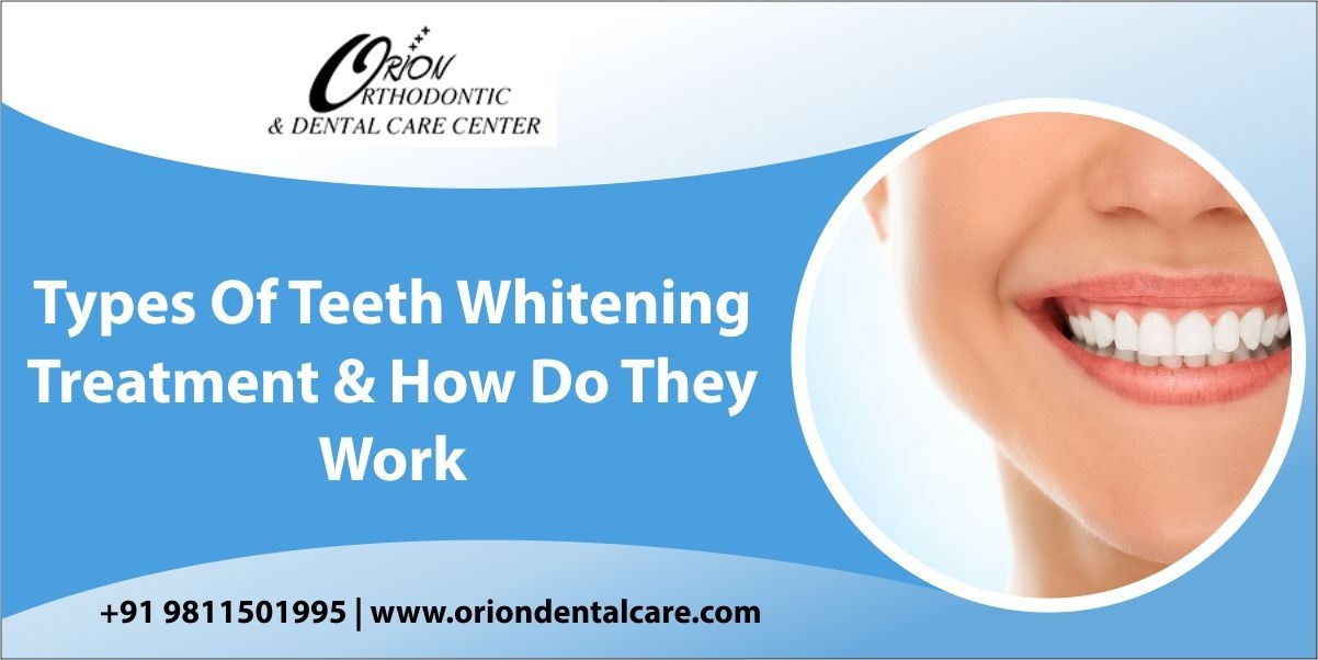 You are currently viewing Types of Teeth Whitening Treatment and How Do They Work?