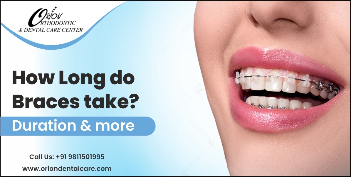 Read more about the article How Long Do Braces take? Duration & More