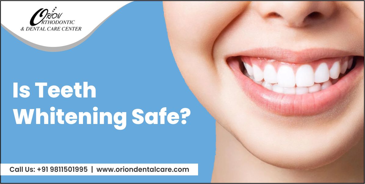 Read more about the article Is Teeth Whitening Safe?