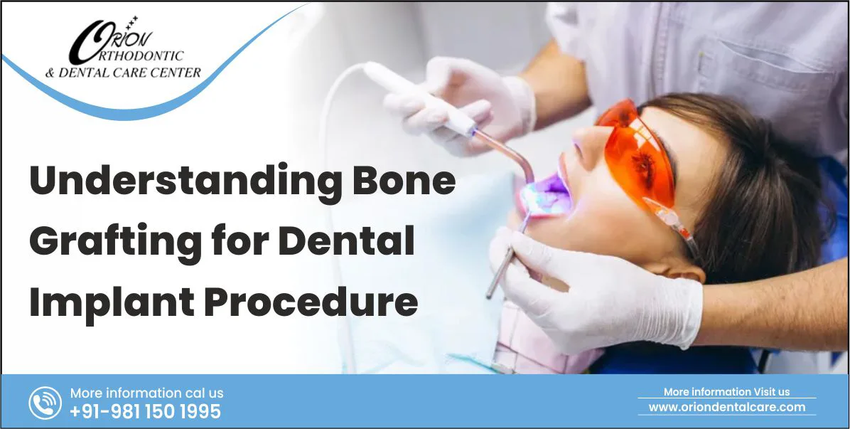 You are currently viewing Bone graft for dental implant