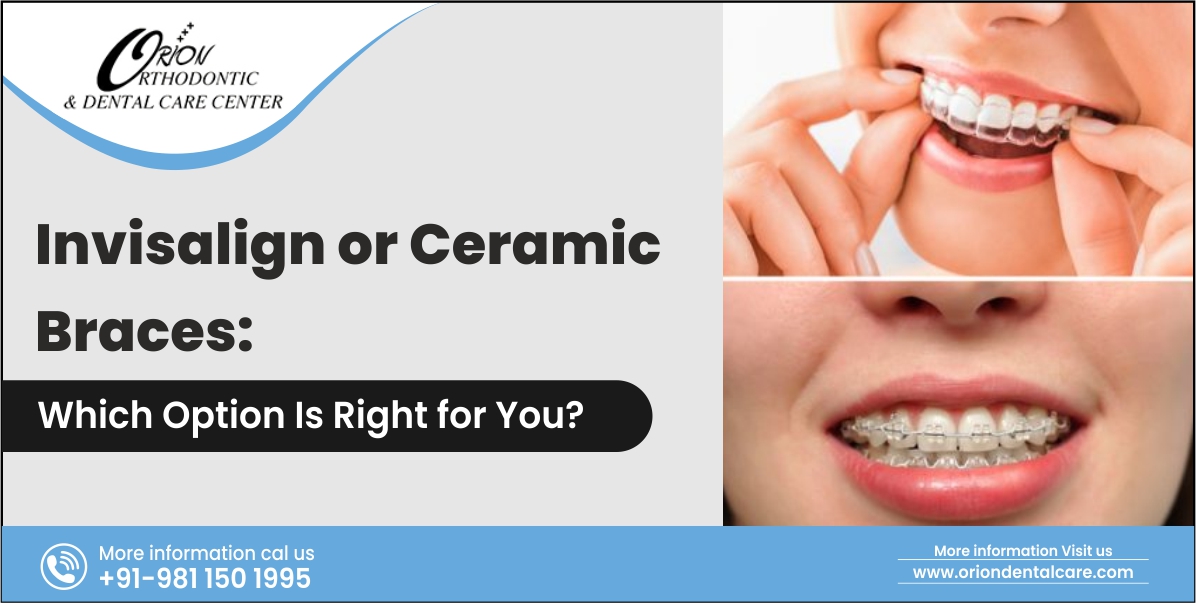 Read more about the article Invisalign or Ceramic Braces: Which Option Is Right for You?