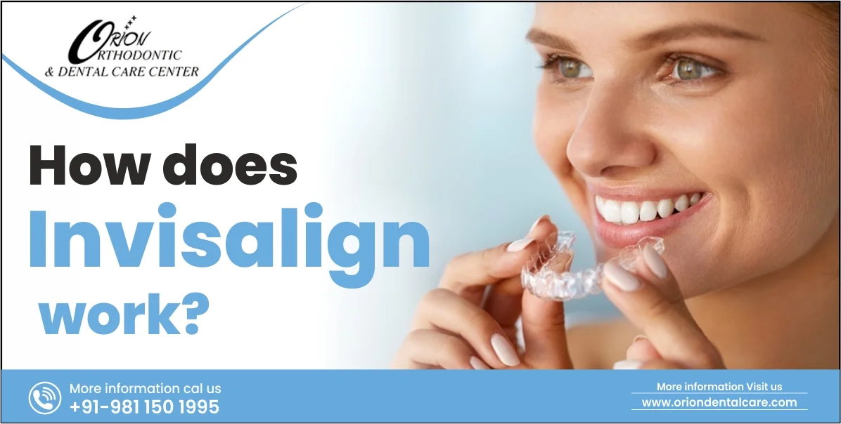 You are currently viewing How does Invisalign work?