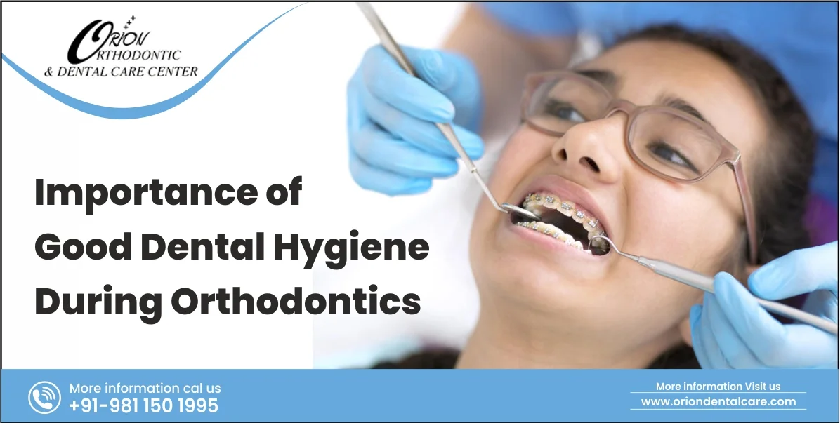 Read more about the article Importance of Good Dental Hygiene during Orthodontics