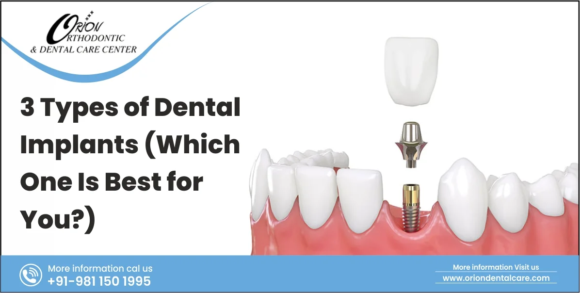 You are currently viewing 3 Types of Dental Implants: Which One Is Best for You?