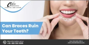Read more about the article Can Braces Ruin Your Teeth?