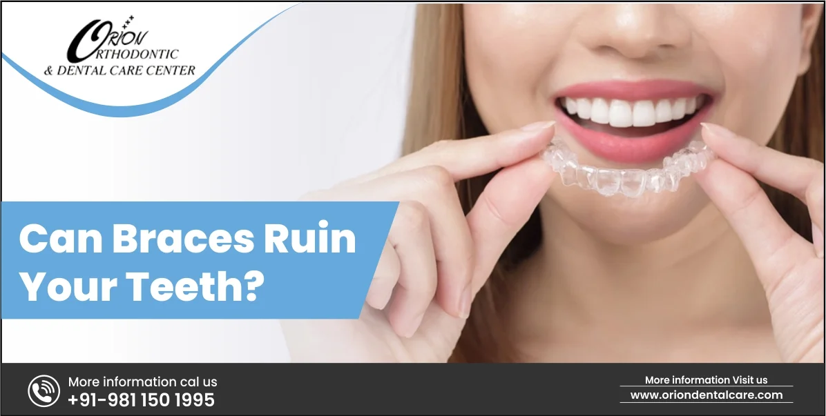 You are currently viewing Can Braces Ruin Your Teeth?