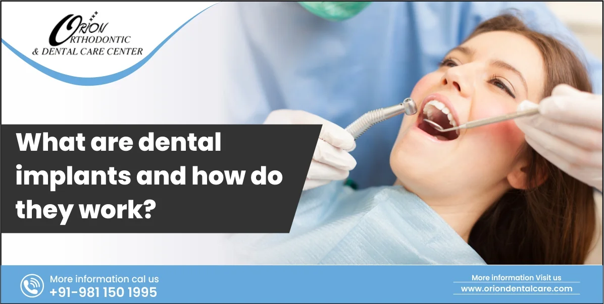Read more about the article What Are Dental Implants and How Do They Work?