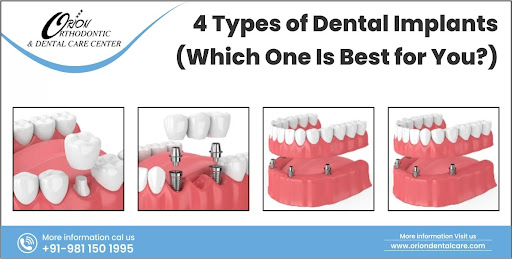 You are currently viewing Types of Dental Implants (Which One Is Best for You?