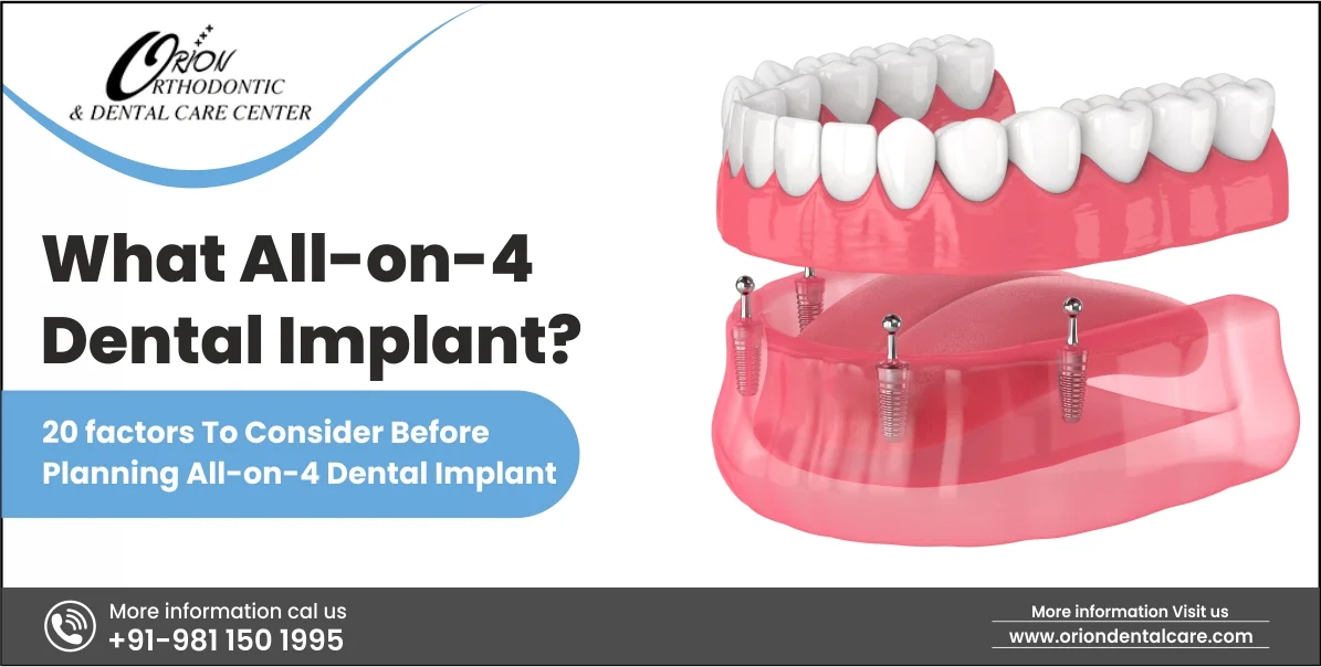 You are currently viewing What All-on-4 Dental Implant? 20 Factors to Consider Before Planning All-on-4 Dental Implant