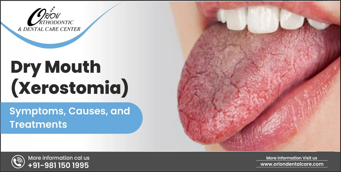 Read more about the article Dry Mouth (Xerostomia): Symptoms, Causes, And Treatments