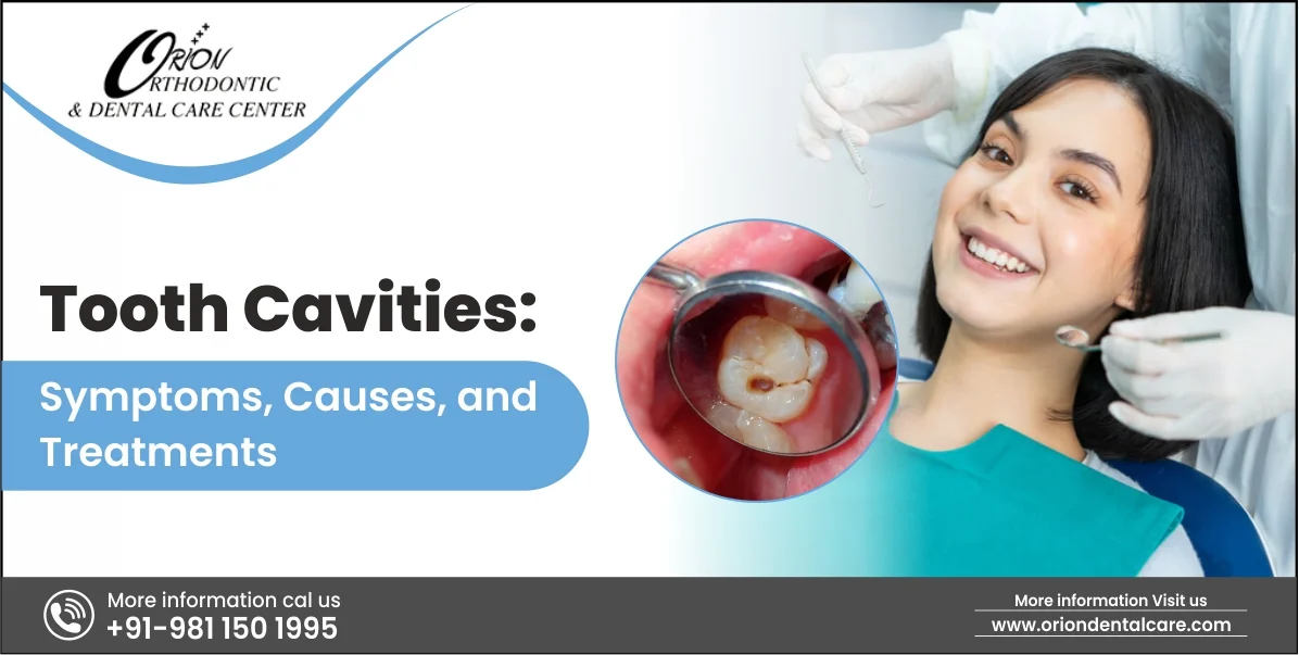 Read more about the article Tooth Cavities: Symptoms, Causes, and Treatments