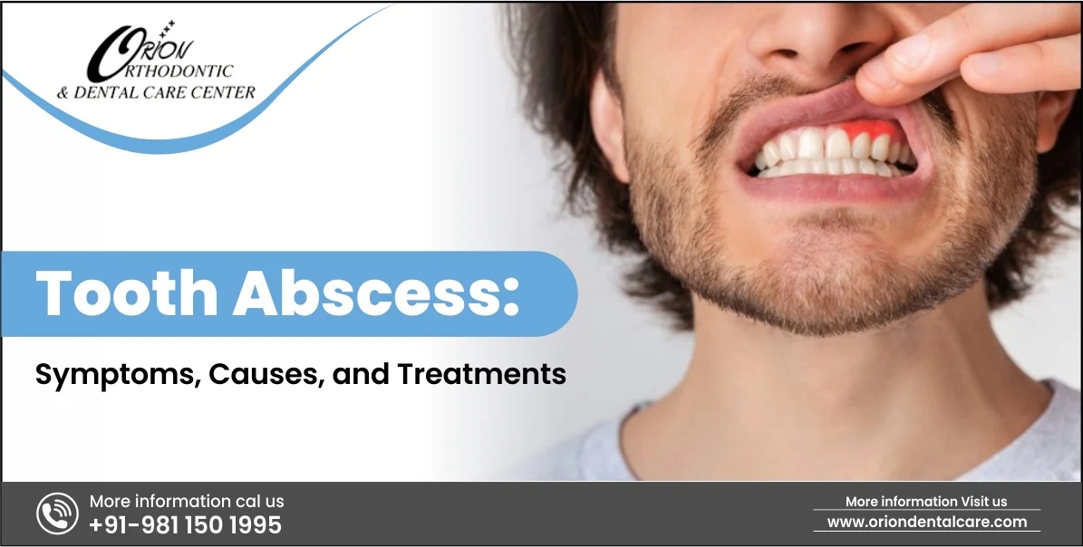 Read more about the article Tooth Abscess: Symptoms, Causes, and Treatment