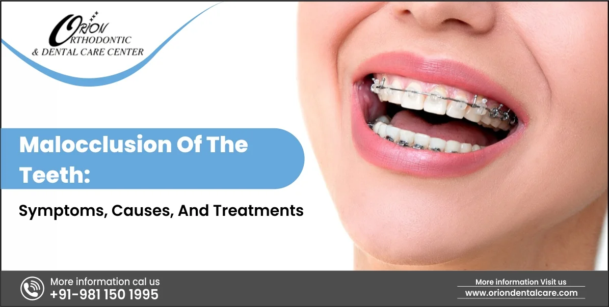 You are currently viewing Malocclusion Of The Teeth: Symptoms, Causes, and Treatments