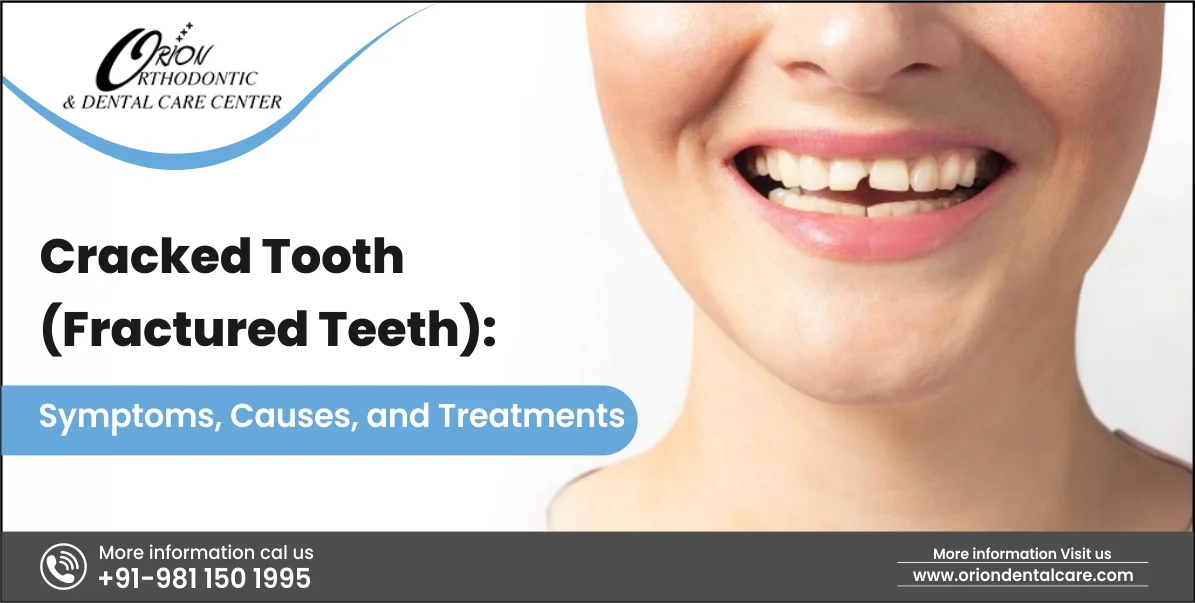 Read more about the article Cracked Tooth (Fractured Tooth): Symptoms, Causes, and Treatments