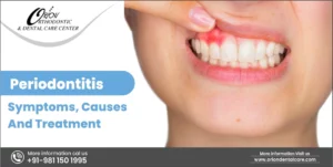 Read more about the article Periodontitis – Symptoms, Causes And Treatment