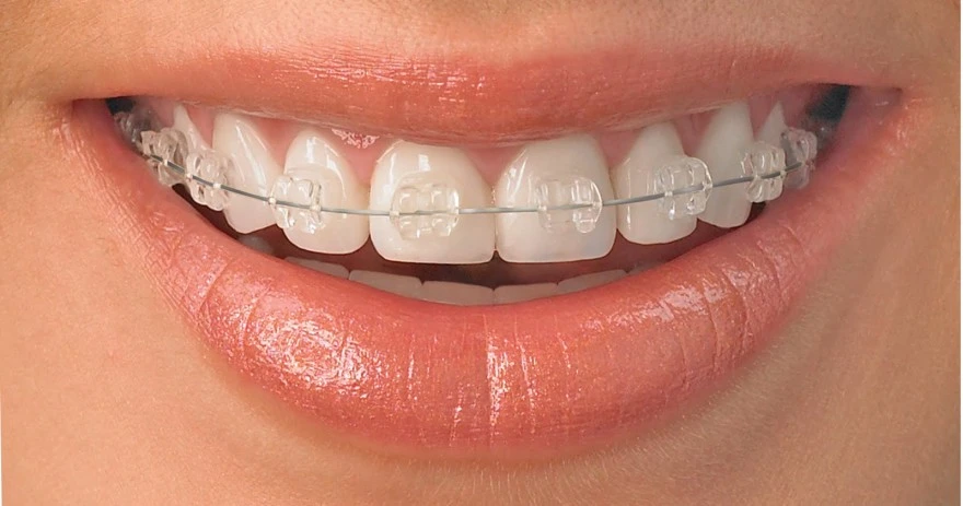 Ceramic-Braces