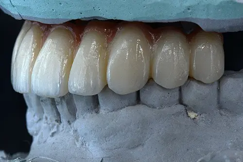 Custom-made implant teeth on a stone model