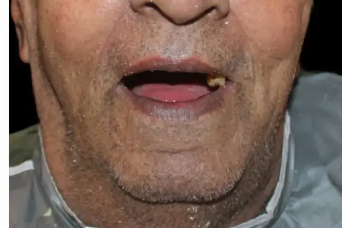 Before: several teeth are missing.