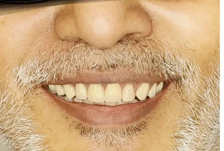 After: the gap is filled and the smile looks complete.